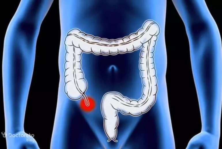 دکتر آپاندیسیت یا التهاب آپاندیس - تبریز