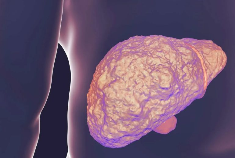 دکتر فیبروز کبدی - شیراز