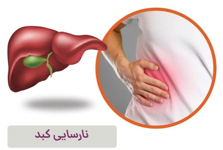 دکتر نارسایی کبد - رشت
